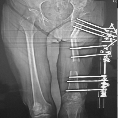 Osteotomía de Soporte Pélvico. Una Técnica de Reconstrucción en Prótesis de Cadera Fallidas o Infección Profunda Severa