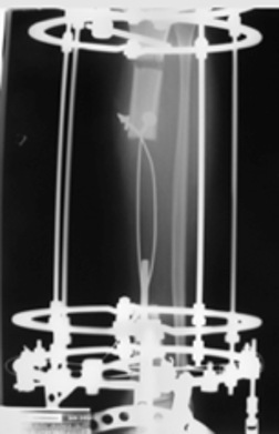 Transporte Óseo con Cables. Una Técnica en Osteogénesis por Distracción