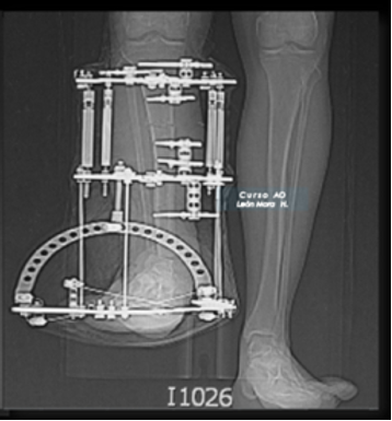 Acortamiento Agudo en Defectos Óseos Postraumaticos o Secuelas de Osteomielitis Crónica
