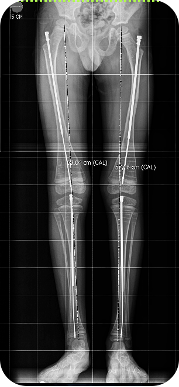 Tratamiento de Deformidades Complejas en Osteogenesis Imperfecta con Clavo Telescópico de Fassier-Duval Endomedular