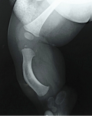 Técnica para la Corrección de la Deformidad en Hemimelia Peroneal 3C. Superankle Modificada
