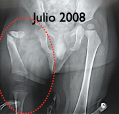 Técnica para la Corrección de Deficiencia Femoral Congénita. Superhip