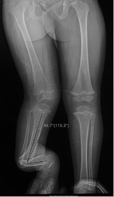 Pseudoartrosis Congénita de Tibia y Peroné
