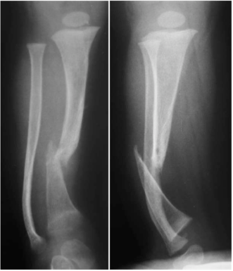 Manejo Quirúrgico de la Pseudoartrosis Congénita de Tibia y Peroné Mediante Método de Chanrley-Williams y Presentación de Modificación Mediante Clavo Telescópico de Fassier-Duval