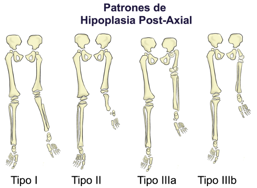 Hipoplasia Postaxial de los Miembros Inferiores. Definición de sus Patrones Clínicos