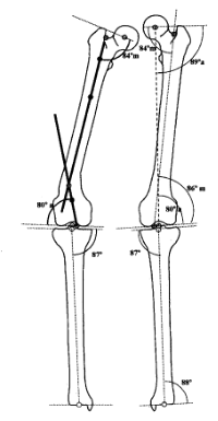 Análisis de las Deformidades Femorales