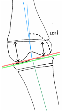Confección de Ligamentos Cruzados en Niños con Ausencia Congénita. Mediante Técnica de Super-Knee.